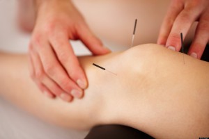 ACUPUNCTURE2