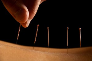 Person-Having-Acupunture-Therapy-on-Their-Back
